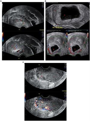 Comparation of abdominal aortic balloon occlusion versus uterine artery embolization in the treatment of cesarean scar pregnancy